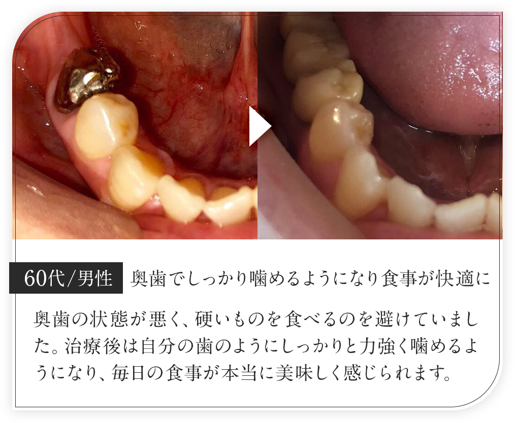 60代男性/奥歯でしっかり噛めるようになり食事が快適に
