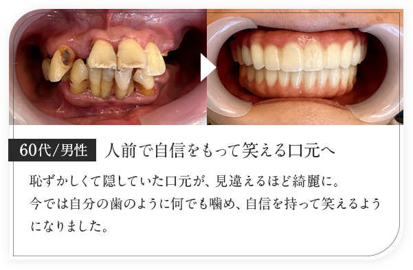 60代男性/人前で自信をもって笑える口元へ