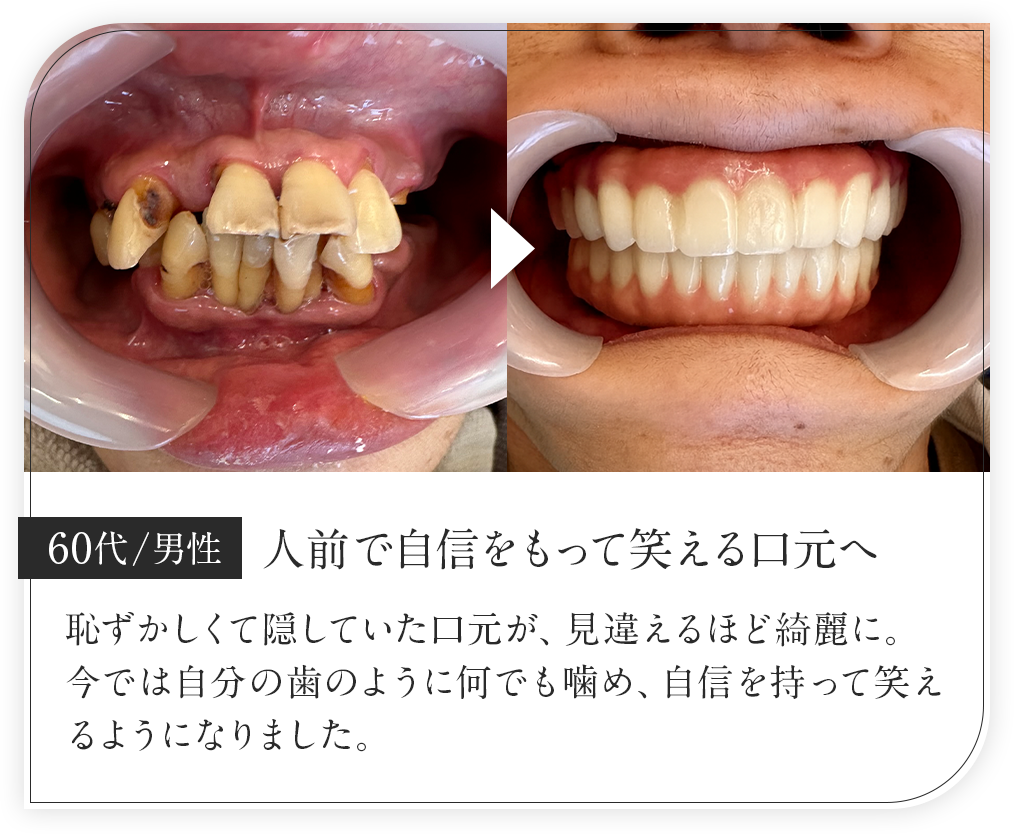 60代男性/人前で自信をもって笑える口元へ